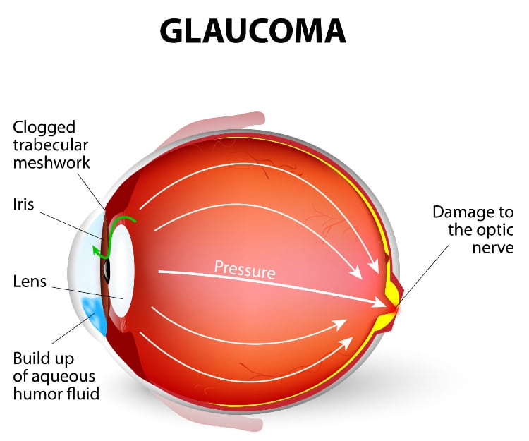 glaucoma-illustration-SK
