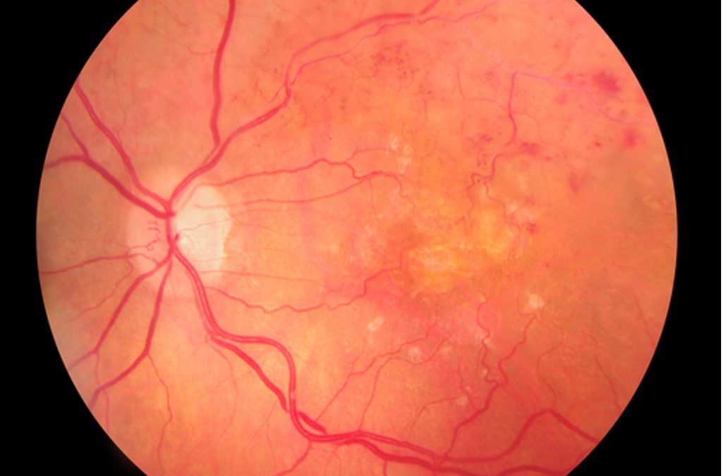 eye and retina