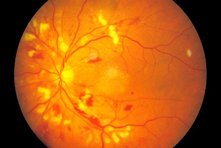 Hypertension and The Eye